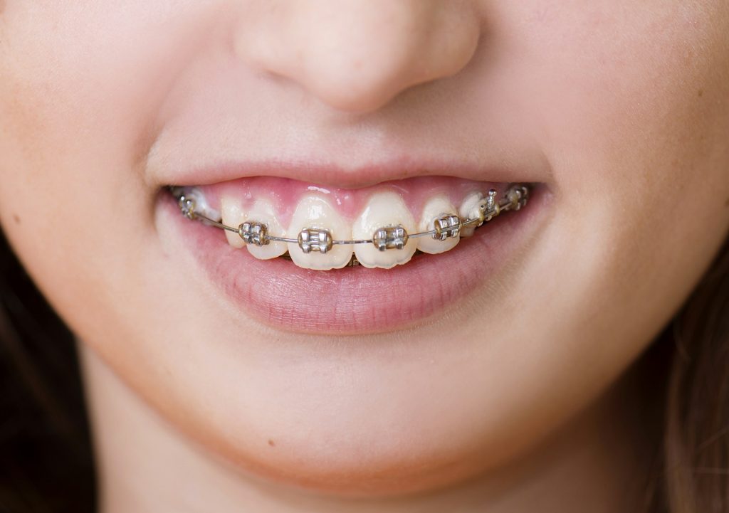 Orthodontie et appareils dentaires